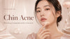 Chin Acne: What Causes It and How to Prevent It